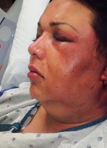 Aliah Hernandez with a swollen and bruised eye. 